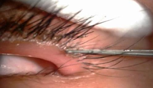 (تصاویر)لانه شپش در چشم دختر 5 ساله (تصاویر)لانه شپش در چشم دختر 5 ساله