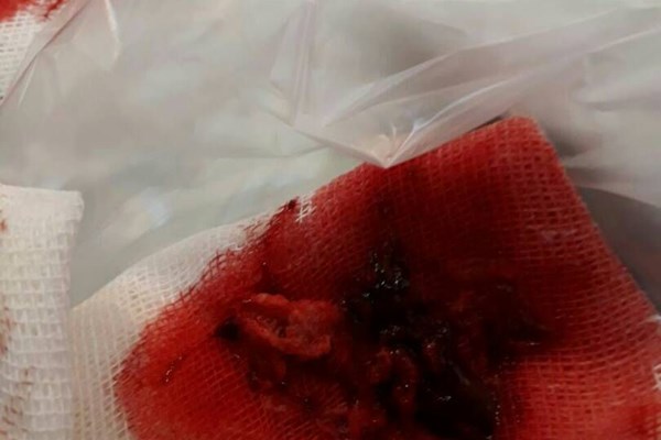 ماجرای جا ماندن گاز پانسمان در بدن بیمار+تصاویر