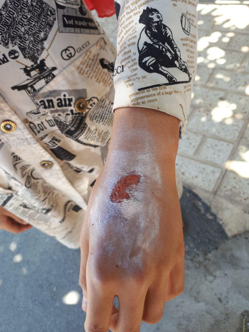 نامادری‌ام صورت و دستم را با اتوی داغ سوزاند!