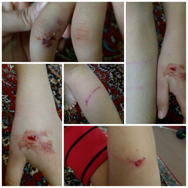 (تصویر) حمله سگ ولگرد به یک کودک ۷ ساله در یک روستا (تصویر) حمله سگ ولگرد به یک کودک ۷ ساله در یک روستا