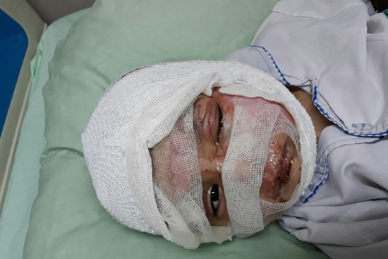 (تصویر) اسیدپاشی روی صورت عمه و برادرزاده اش (تصویر) اسیدپاشی روی صورت عمه و برادرزاده اش