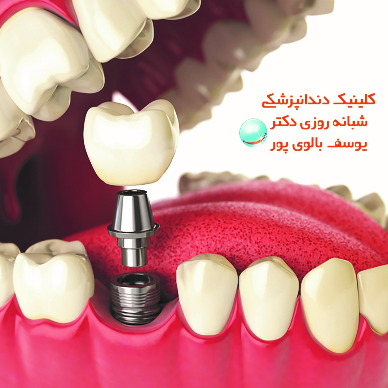 همه چیز درباره ی ایمپلنت و کامپوزیت دندان