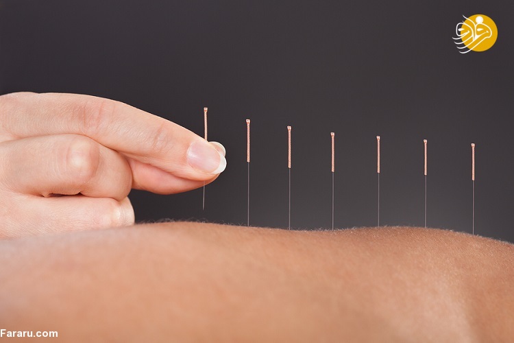 طب سوزنی چیست؟