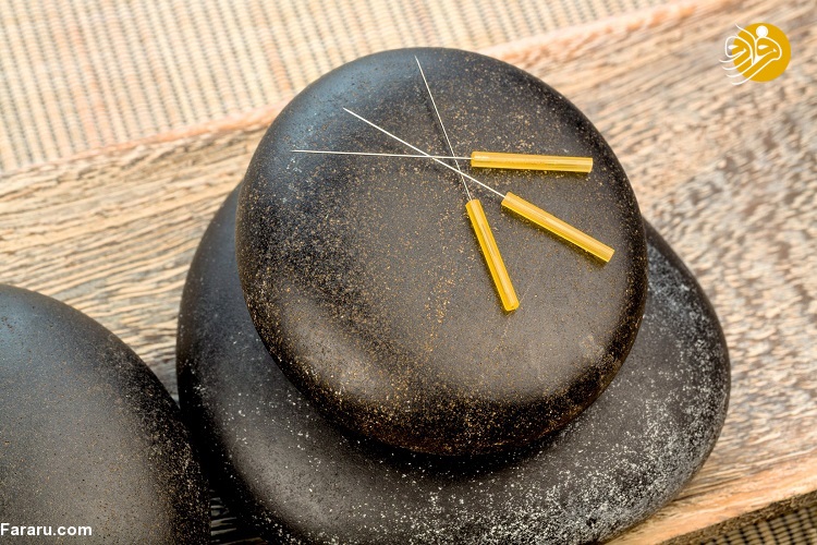 طب سوزنی چیست؟