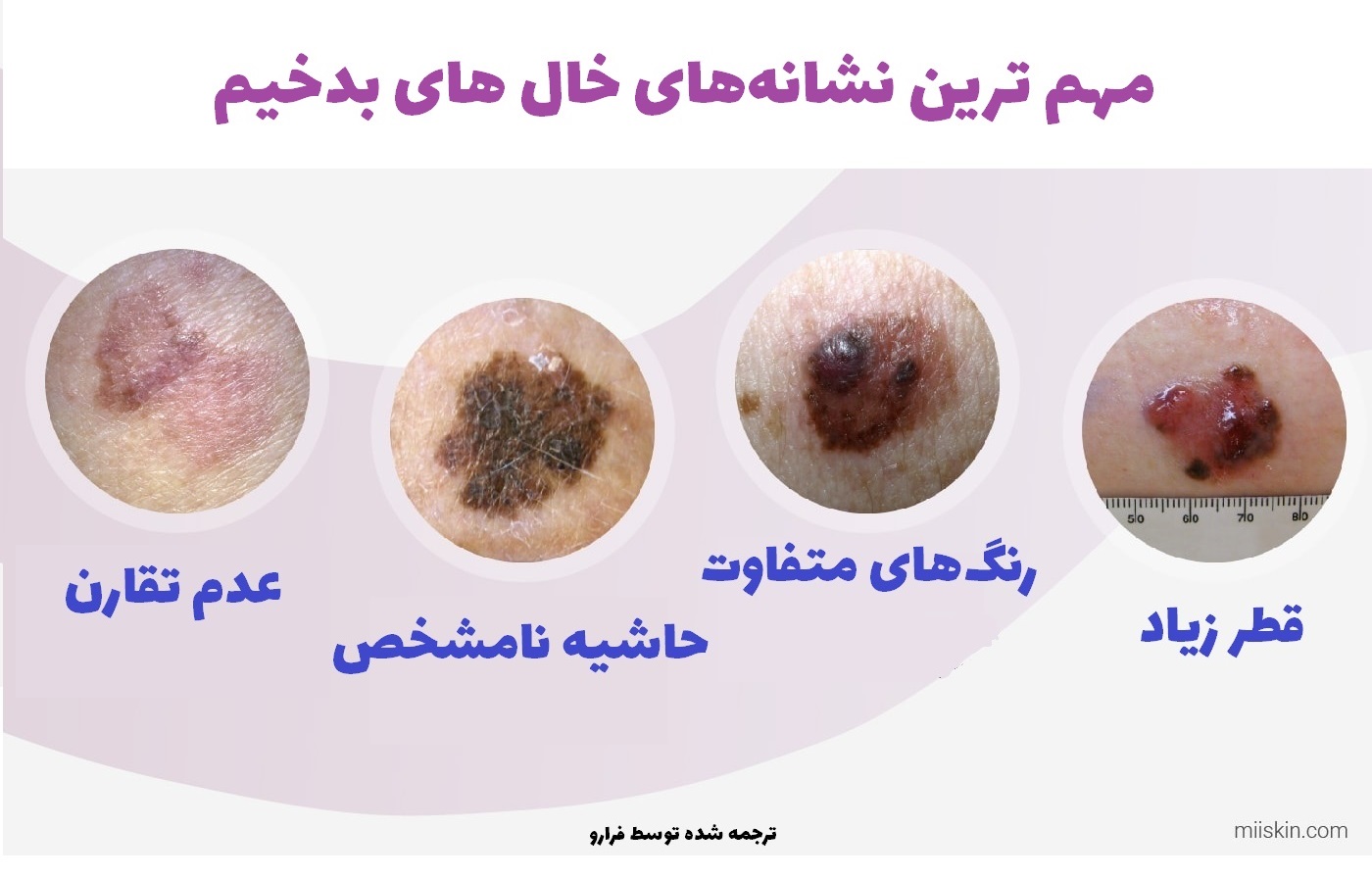 خال خوش خیم و بدخیم چه تفاوتی دارند؟
