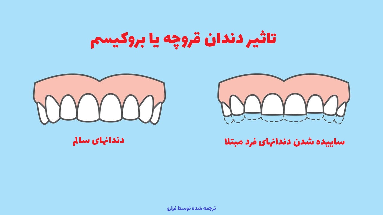 دندان قروچه چیست؟ علت ایجاد و بهترین درمان های خانگی برای آن کدام است؟