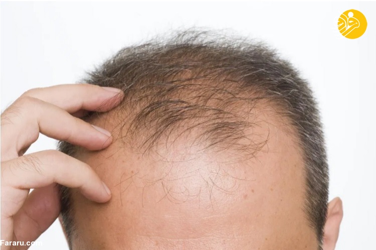 دلایل رایج ریزش مو در تابستان و پاییز چیست؟ دلایل رایج ریزش مو در تابستان و پاییز چیست؟