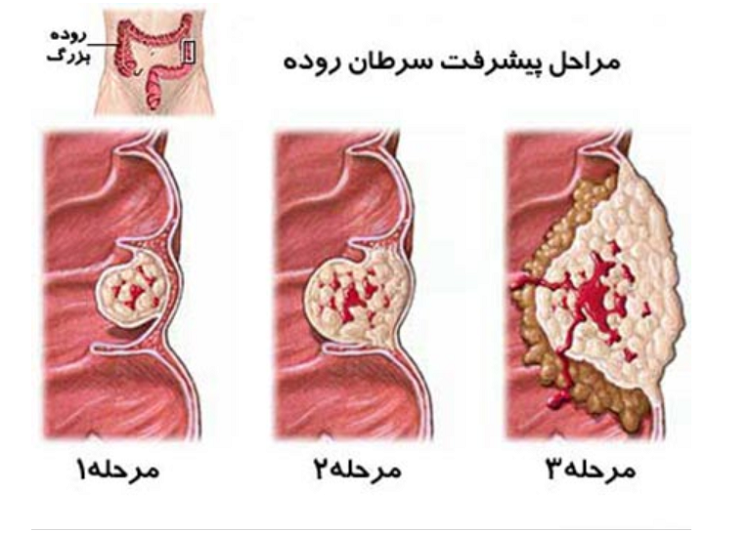مراحل پیشرفت سرطان روده بزرگ سرطان روده بزرگ؛ علت، نشانهها و راههای درمان آن