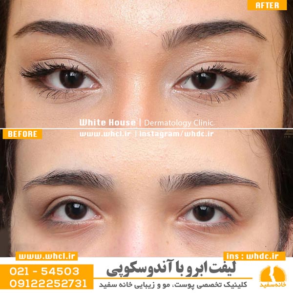 با لیفت ابرو، شکلی ایده آل به ابروی خود بدهید !