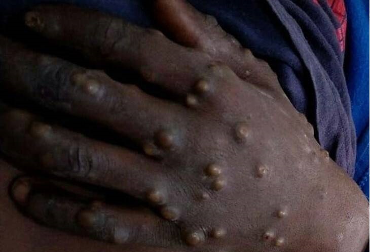 همه چیز درباره ویروس آبله میمونی همه چیز درباره ویروس آبله میمونی