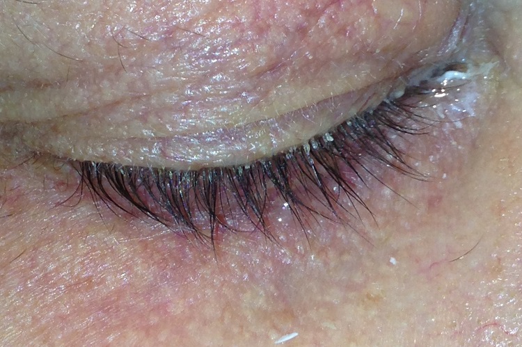  Demodex folliculorum