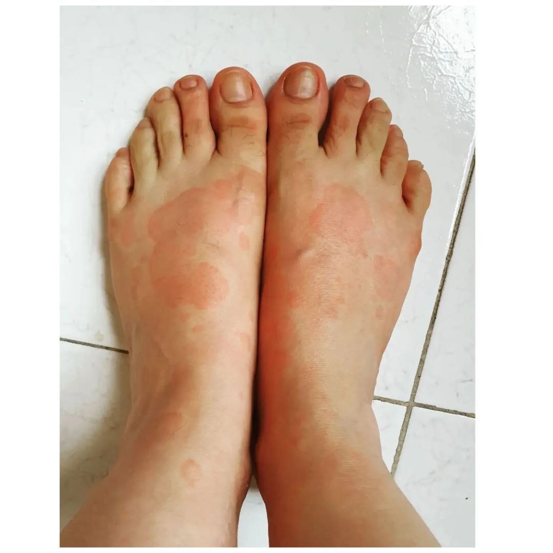 عکس‌هایی از بیماری آناهیتا همتی در اثر آلودگی هوای تهران