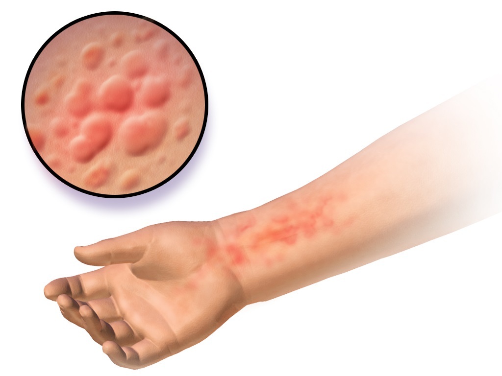 کهیر چیست و چه علائمی دارد؟