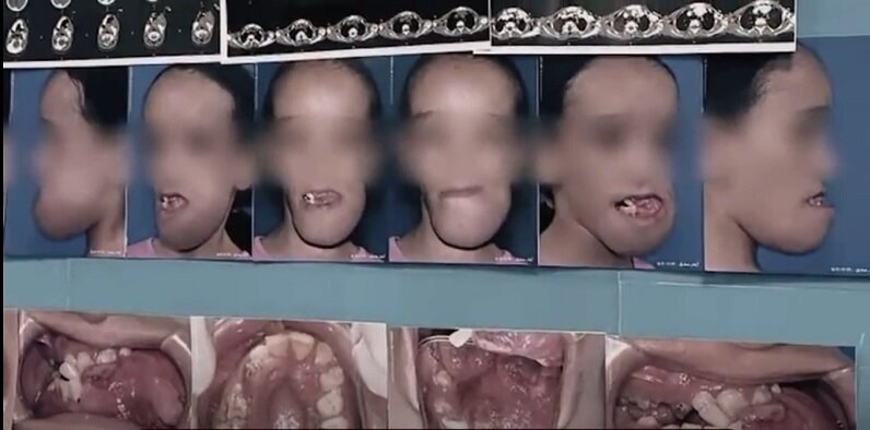 (تصویر) خارج کردن تومور ۷ کیلویی از دهان کودک ۱۱ ساله!
