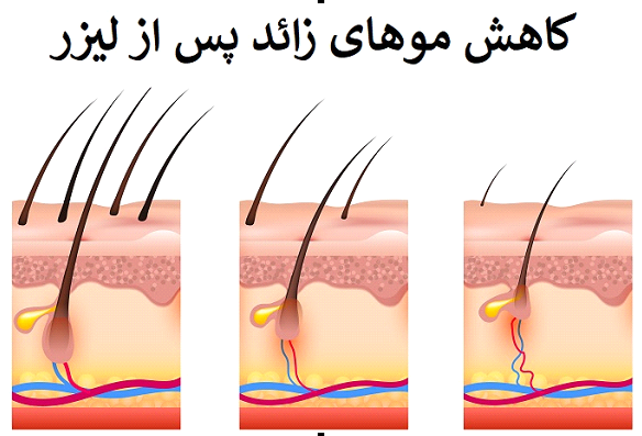 عوارض لیزر زیر بغل و بیکینی؛ هر آنچه باید بدانید /// آگهی عوارض لیزر زیر بغل و بیکینی؛ هر آنچه باید بدانید /// آگهی
