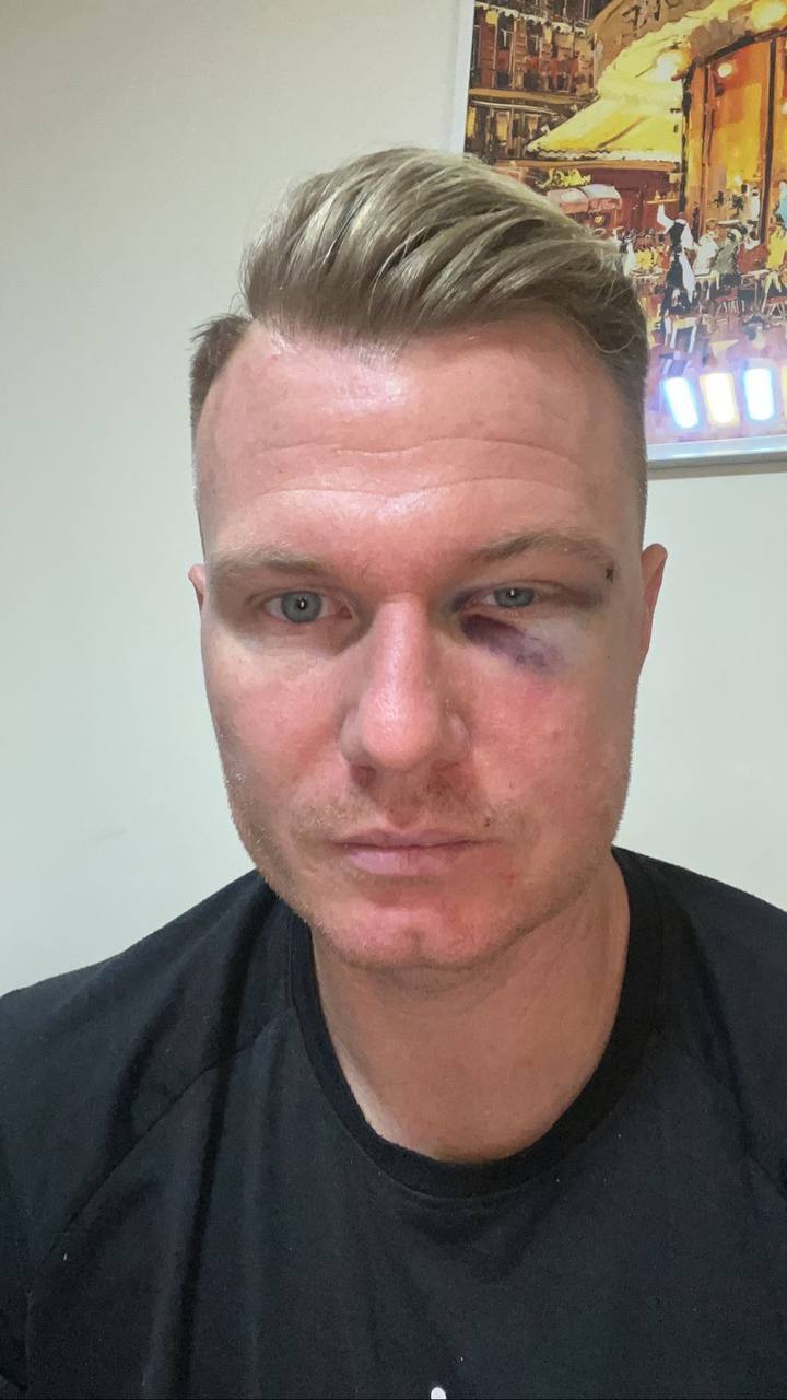 (عکس) اتفاق دردناکی که پای چشم دروازه‌بان فولاد کاشته شد