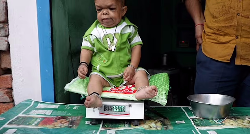 مرد ۶۰ سانتیمتری هندی که از ۵ سالگی دیگر رشد نکرد و تنها ۷ کیلو وزن دارد