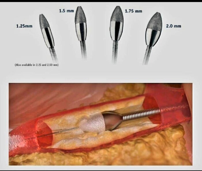 پای الماس به جراحی قلب در ایران باز شد